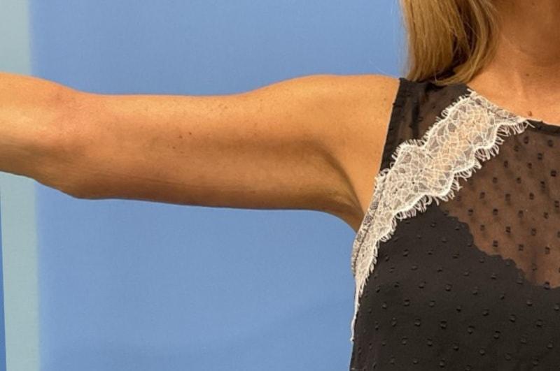 Andrew Smith, MD, FACS arm lift after — Irvine, CA