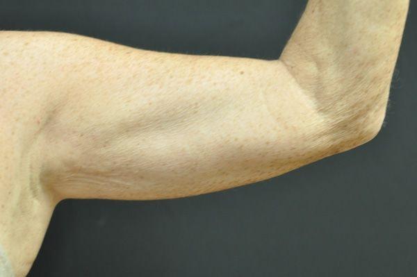 CoolSculpting before at Andrew Smith, MD, FACS in Irvine, CA