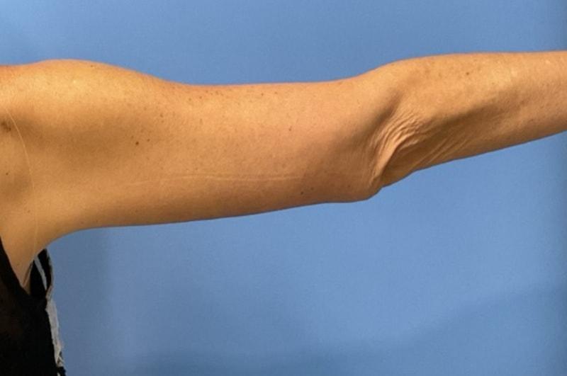 Andrew Smith, MD, FACS arm lift after — Irvine, CA