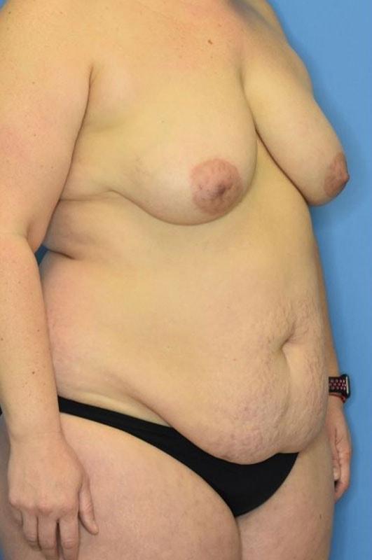 Mommy Makeover before at Andrew Smith, MD, FACS in Irvine, CA
