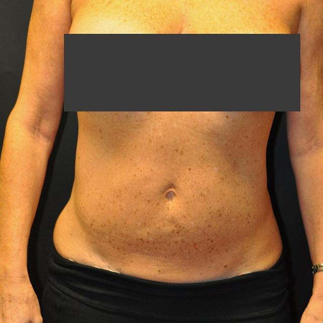 Liposuction after at Andrew Smith, MD, FACS in Irvine, CA
