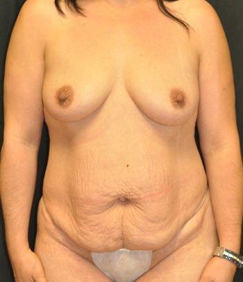 Mommy Makeover before at Andrew Smith, MD, FACS in Irvine, CA