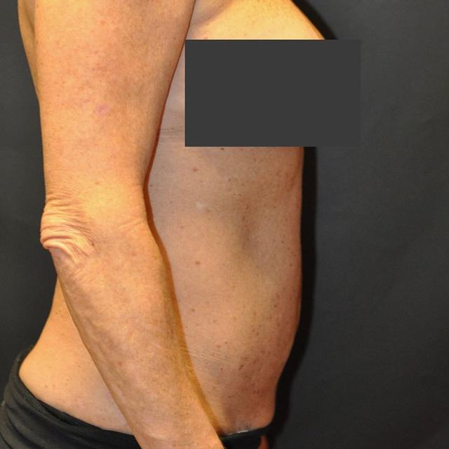 Liposuction after at Andrew Smith, MD, FACS in Irvine, CA