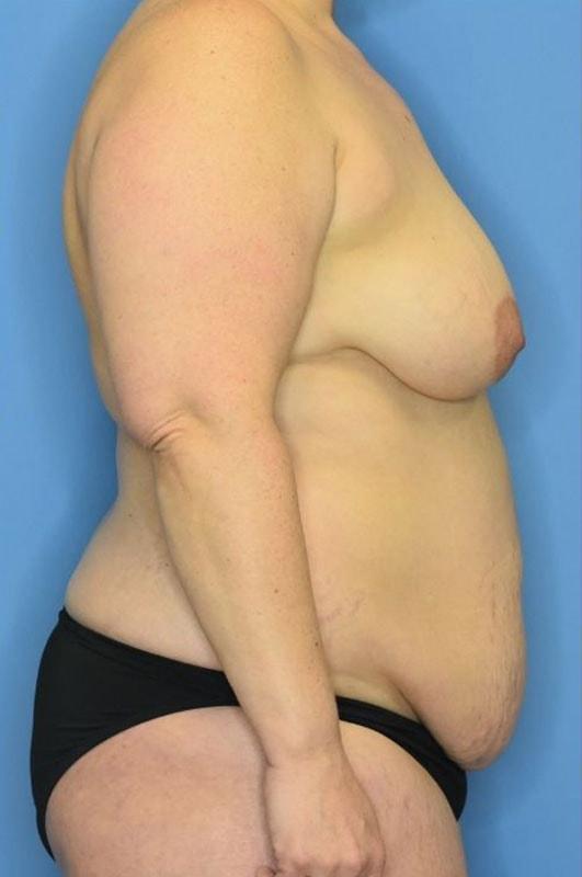 Mommy Makeover before at Andrew Smith, MD, FACS in Irvine, CA
