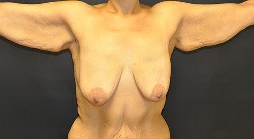 Breast Lift before at Andrew Smith, MD, FACS in Irvine, CA