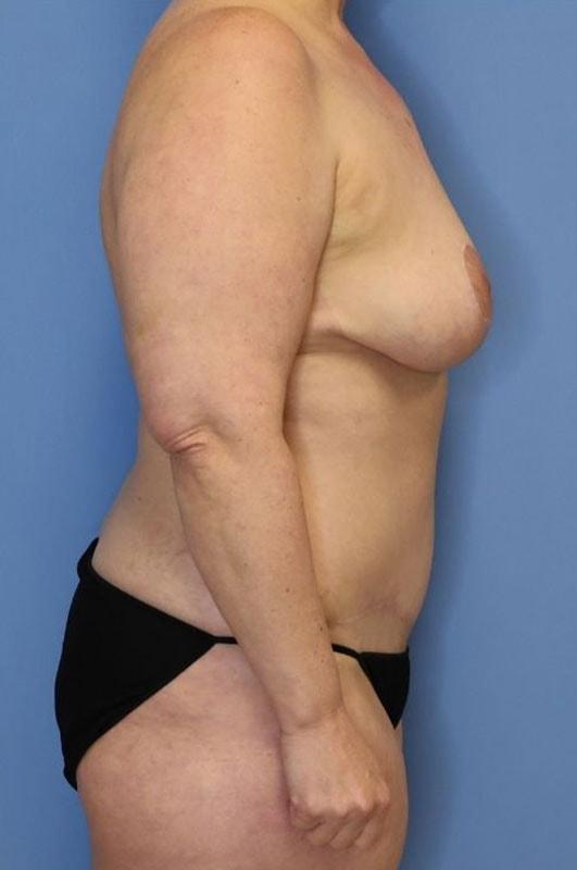 Mommy Makeover after at Andrew Smith, MD, FACS in Irvine, CA
