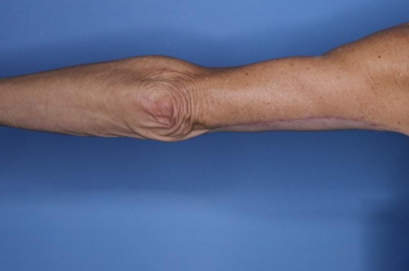 Andrew Smith, MD, FACS arm lift after — Irvine, CA