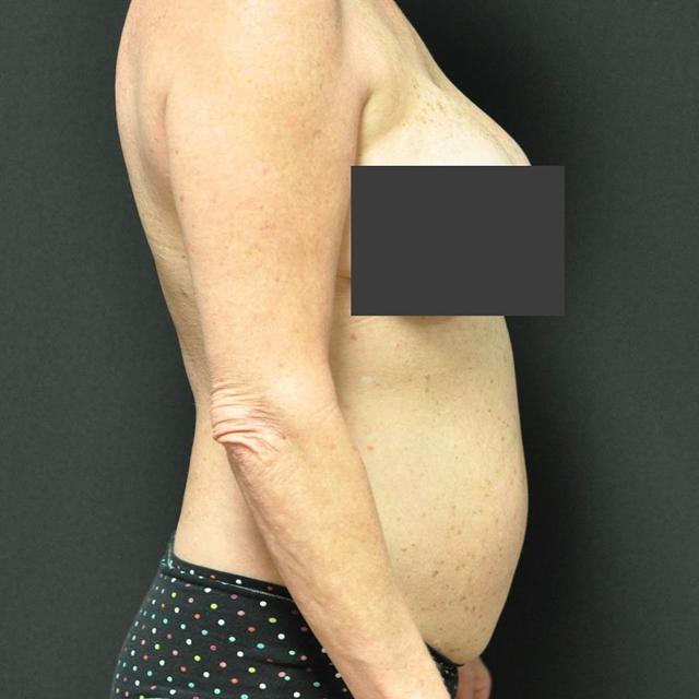 Liposuction before at Andrew Smith, MD, FACS in Irvine, CA