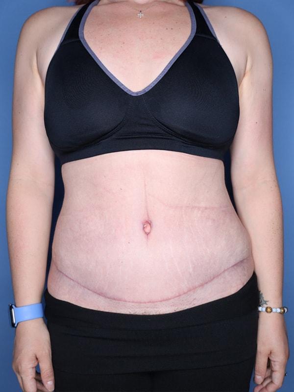 Tummy Tuck after at Andrew Smith, MD, FACS in Irvine, CA