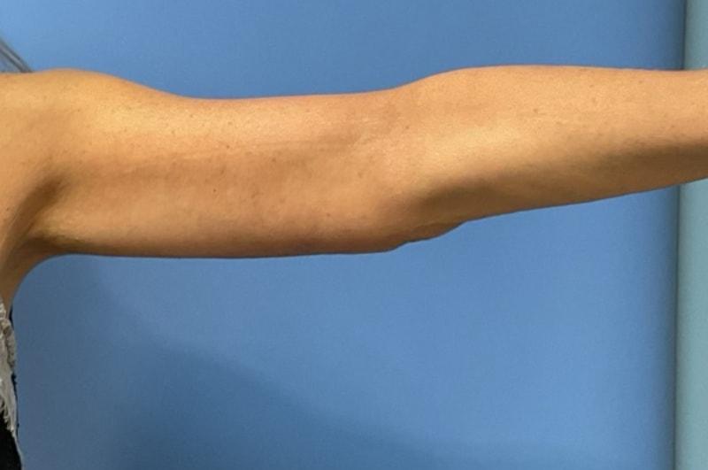 Andrew Smith, MD, FACS arm lift after — Irvine, CA