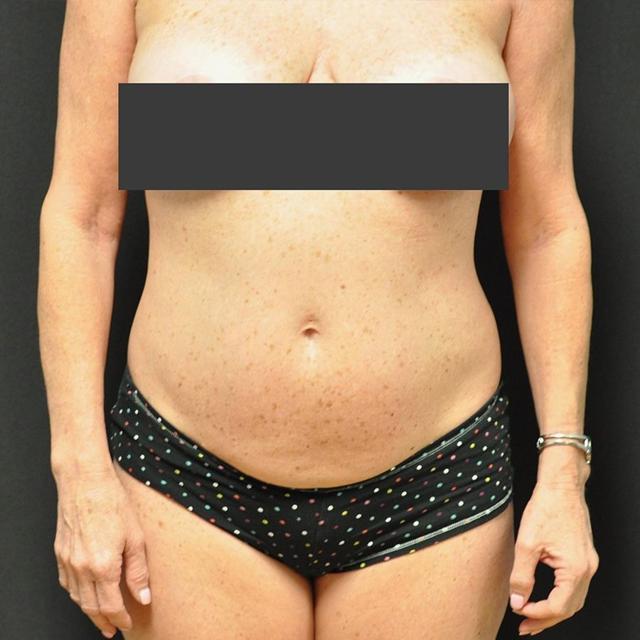 Liposuction before at Andrew Smith, MD, FACS in Irvine, CA