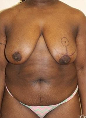 Mommy Makeover before at Jordan M.S. Jacobs, MD in Scarsdale, NY