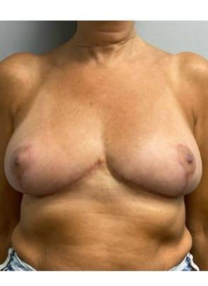 Jordan M.S. Jacobs, MD breast reduction after — Scarsdale, NY