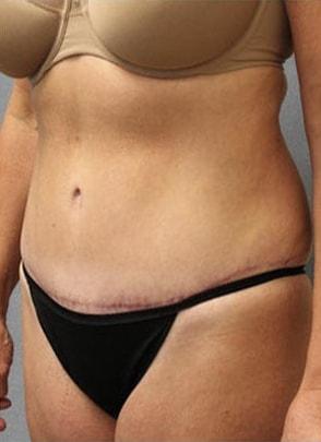 Mommy Makeover after at Jordan M.S. Jacobs, MD in Scarsdale, NY