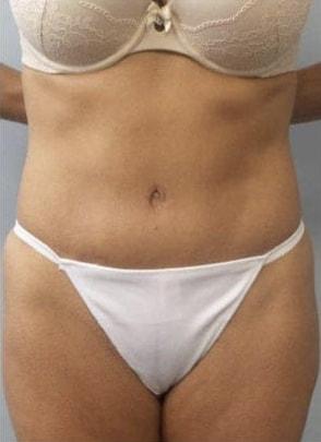 Jordan M.S. Jacobs, MD tummy tuck after — Scarsdale, NY