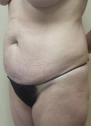 Mommy Makeover before at Jordan M.S. Jacobs, MD in Scarsdale, NY
