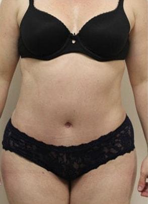 Jordan M.S. Jacobs, MD tummy tuck after — Scarsdale, NY