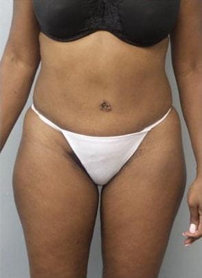 Jordan M.S. Jacobs, MD tummy tuck after — Scarsdale, NY