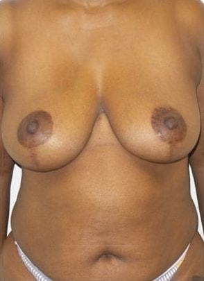 Jordan M.S. Jacobs, MD breast reduction after — Scarsdale, NY