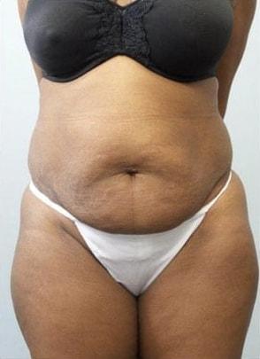 Mommy Makeover before at Jordan M.S. Jacobs, MD in Scarsdale, NY