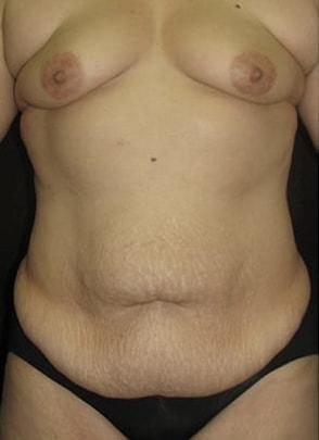 Mommy Makeover before at Jordan M.S. Jacobs, MD in Scarsdale, NY