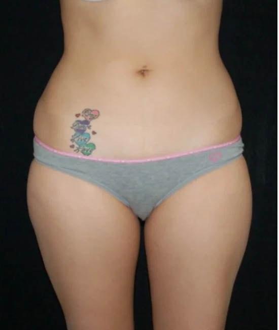 Liposuction before at Gary Motykie, MD in West Hollywood, CA