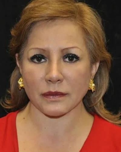 Facelift after at Gary Motykie, MD in West Hollywood, CA