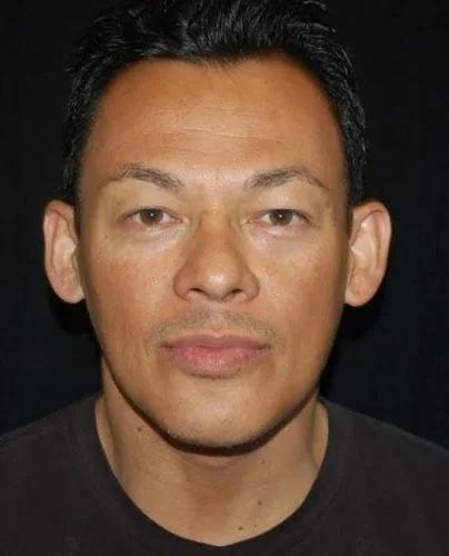 Blepharoplasty before at Gary Motykie, MD in West Hollywood, CA
