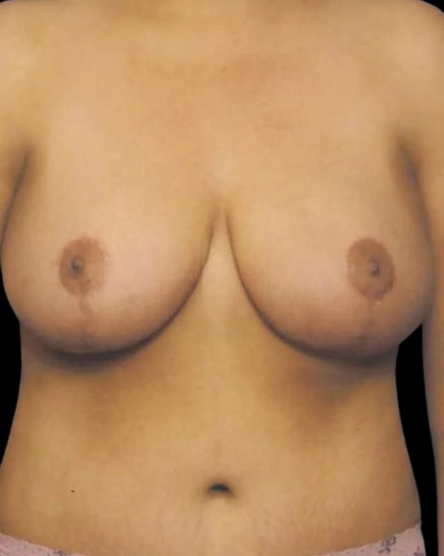 Mommy Makeover after at Gary Motykie, MD in West Hollywood, CA