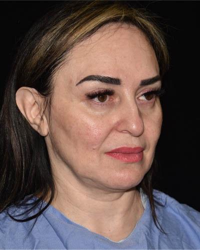 Facelift before at Gary Motykie, MD in West Hollywood, CA