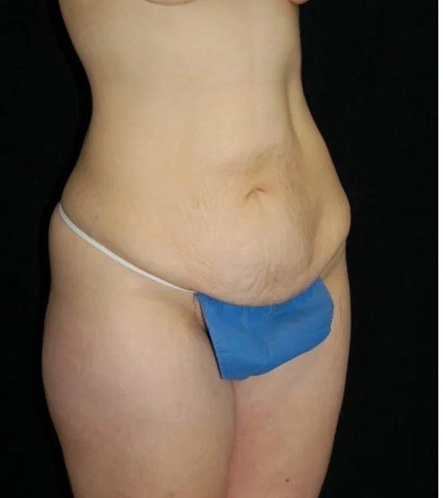 Mini Tummy Tuck before at Gary Motykie, MD in West Hollywood, CA