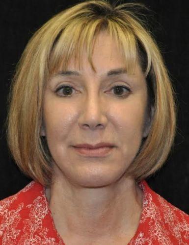 Blepharoplasty after at Gary Motykie, MD in West Hollywood, CA