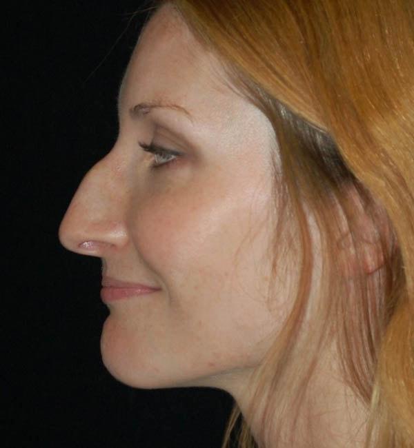 Rhinoplasty before at Gary Motykie, MD in West Hollywood, CA