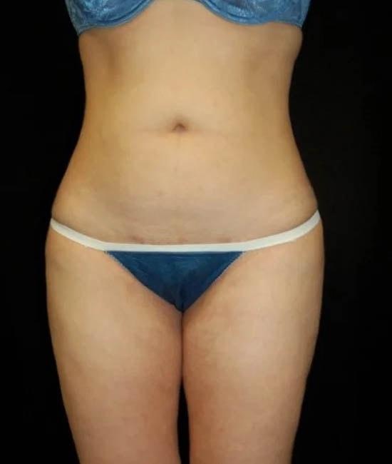 Liposuction after at Gary Motykie, MD in West Hollywood, CA