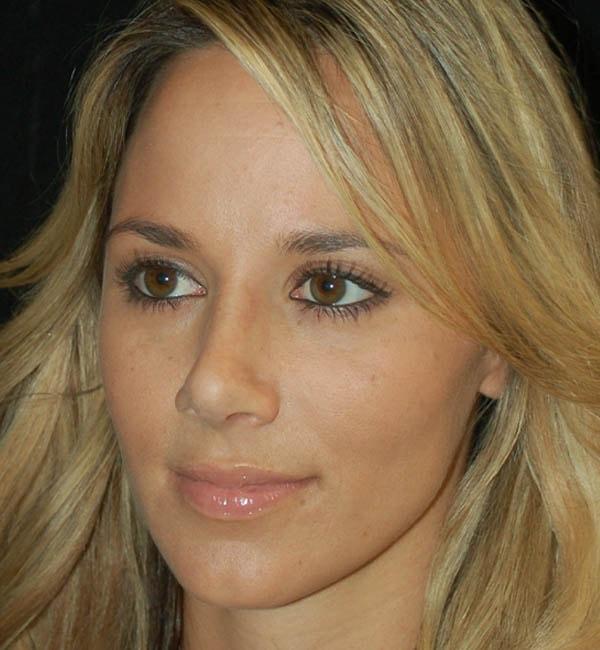 Gary Motykie, MD rhinoplasty after — West Hollywood, CA