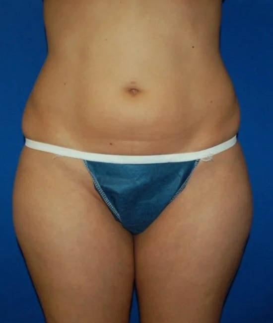 Liposuction before at Gary Motykie, MD in West Hollywood, CA