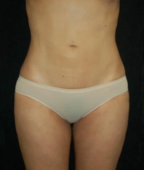 Liposuction after at Gary Motykie, MD in West Hollywood, CA