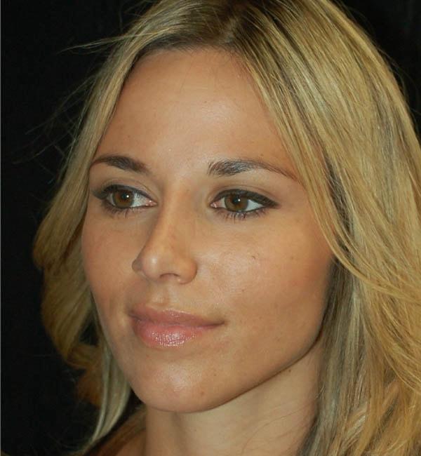 Rhinoplasty after at Gary Motykie, MD in West Hollywood, CA