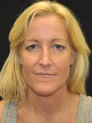 Blepharoplasty before at Gary Motykie, MD in West Hollywood, CA