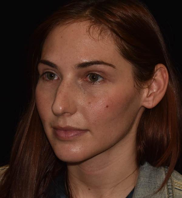 Rhinoplasty before at Gary Motykie, MD in West Hollywood, CA