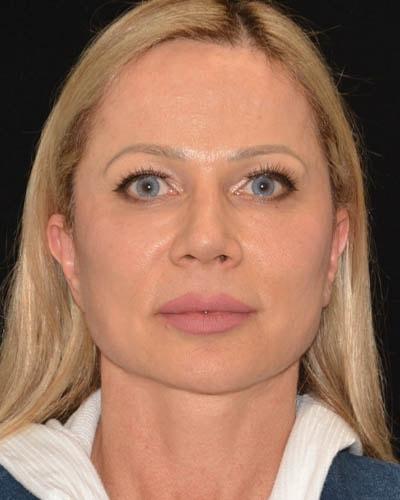 Facelift after at Gary Motykie, MD in West Hollywood, CA