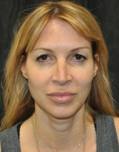 Blepharoplasty before at Gary Motykie, MD in West Hollywood, CA