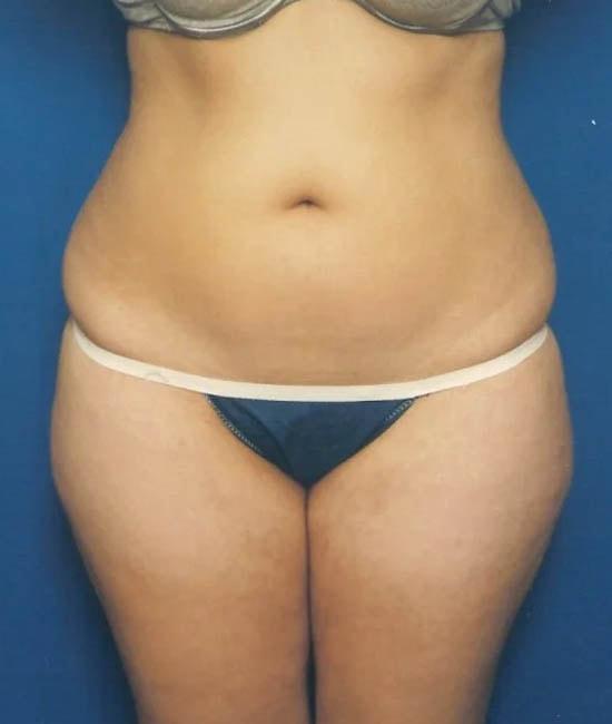 Liposuction before at Gary Motykie, MD in West Hollywood, CA