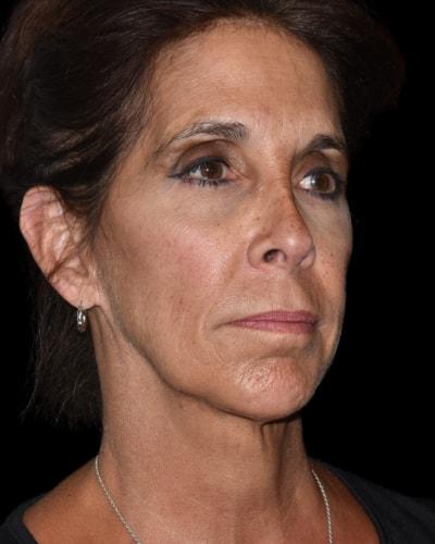 Facelift before at Gary Motykie, MD in West Hollywood, CA