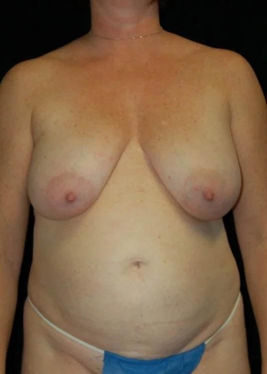 Breast Lift before at Gary Motykie, MD in West Hollywood, CA