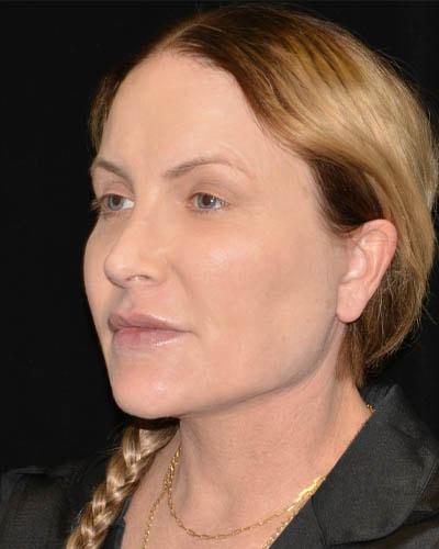 Facelift after at Gary Motykie, MD in West Hollywood, CA