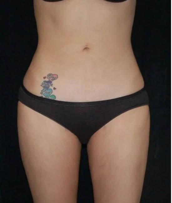 Liposuction after at Gary Motykie, MD in West Hollywood, CA