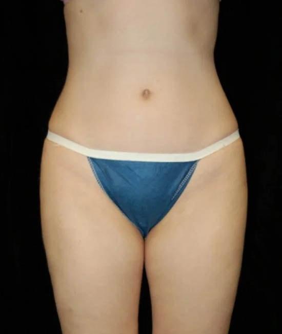 Liposuction after at Gary Motykie, MD in West Hollywood, CA