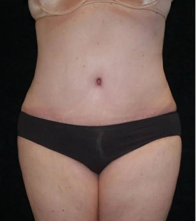 Mini Tummy Tuck after at Gary Motykie, MD in West Hollywood, CA