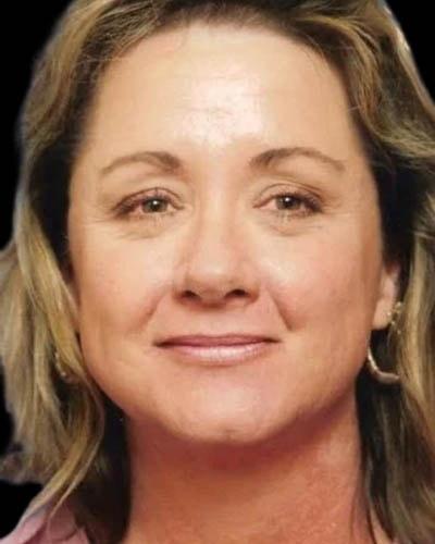 Blepharoplasty before at Gary Motykie, MD in West Hollywood, CA